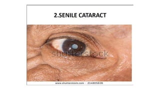 Cataract | PPT