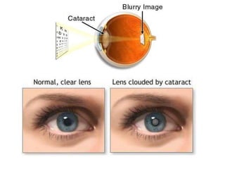 Cataract | PPTX