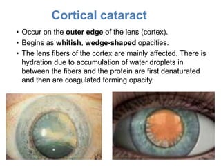 Cataract | PPTX