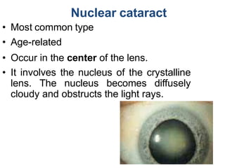 Cataract | PPTX
