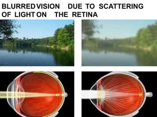 Cataract | PPTX