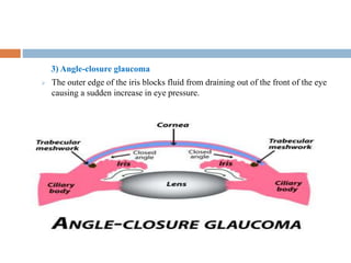 3) Angle-closure glaucoma
 The outer edge of the iris blocks fluid from draining out of the front of the eye
causing a sudden increase in eye pressure.
 