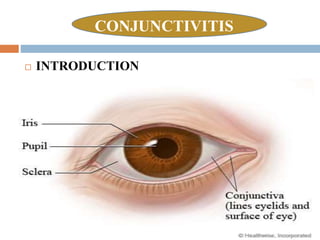 CONJUNCTIVITIS
 INTRODUCTION
 