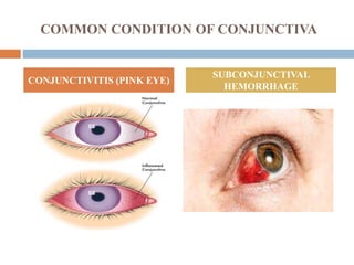 COMMON CONDITION OF CONJUNCTIVA
CONJUNCTIVITIS (PINK EYE)
SUBCONJUNCTIVAL
HEMORRHAGE
 