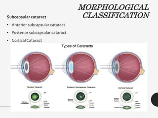 MORPHOLOGICAL
CLASSIFICATION
Subcapsular cataract
• Anterior subcapsular cataract
• Posterior subcapsular cataract
• Cortical Cataract
 