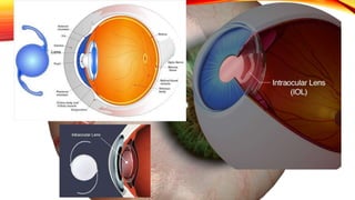 cataract.pptx