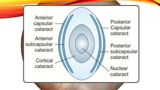Cataract Structure cataract.pptx