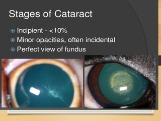 Cataract in short for mbbs students.pptx