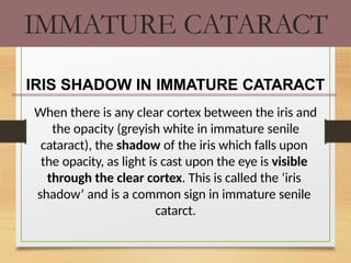 immature senile cataract iris shadow Images High... Cataract in short for mbbs students.pptx