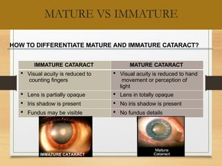 immature senile cataract iris shadow Images High... Cataract in short for mbbs students.pptx