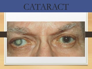 Cataract in short for mbbs students.pptx