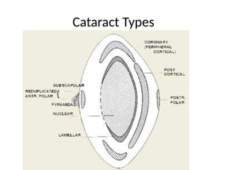 CATARACT a short introduction and management.pptx