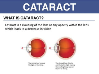Cataract.pptx...................................... | PPTX