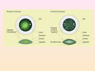 Cataract Structure Cataract | PPT
