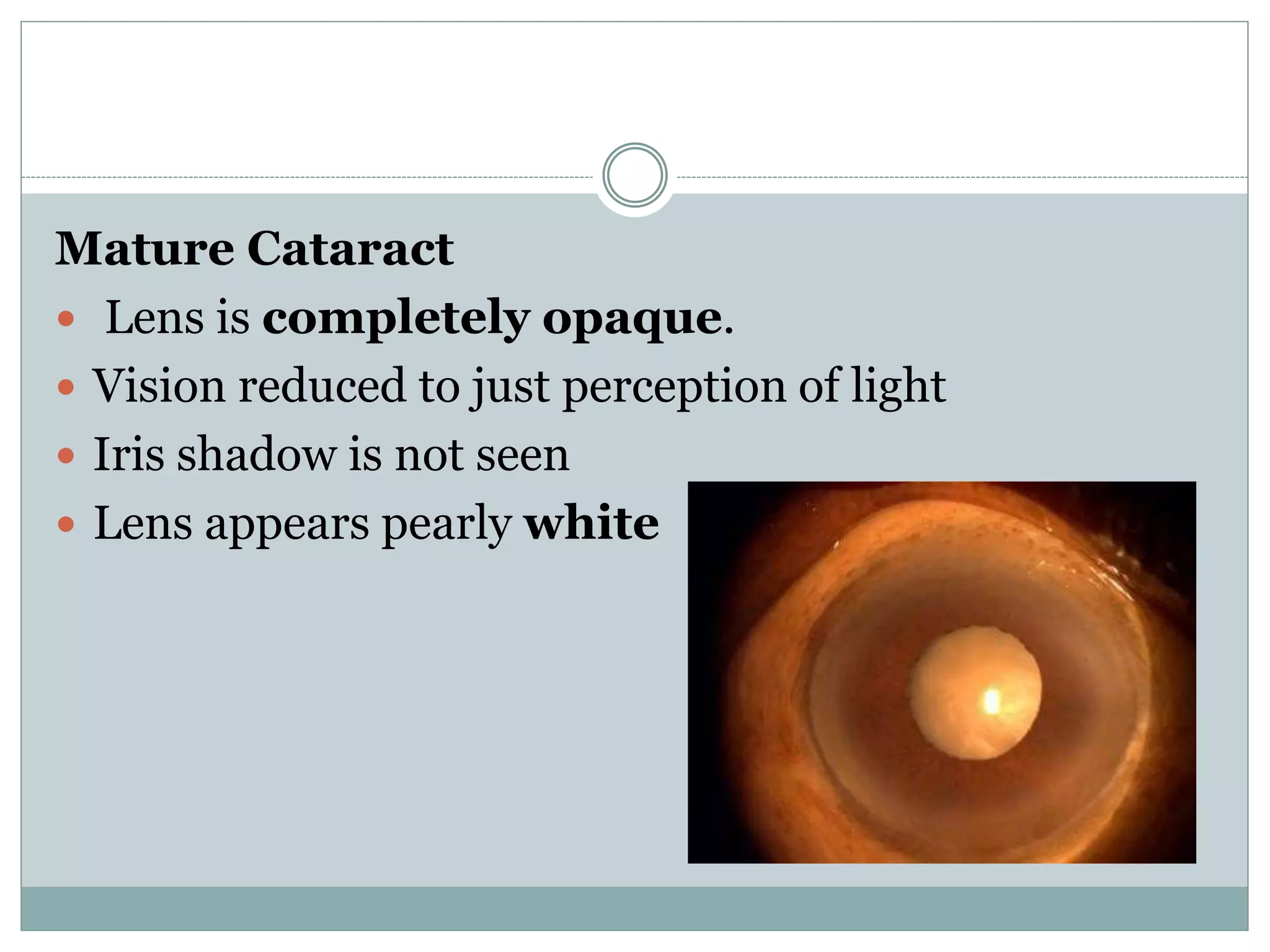 Cataract-Ppt.pptx