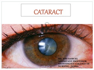 CATARACT
MS. SIBI SAMUEL
ASSISSTANT PROFESSOR
NIGHTINGALE COLLEGE OF
NURSING , NOIDA
 