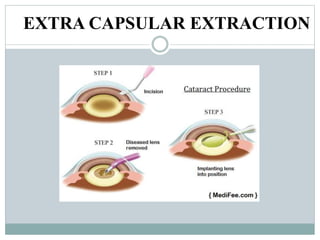 Cataract-Ppt.pptx