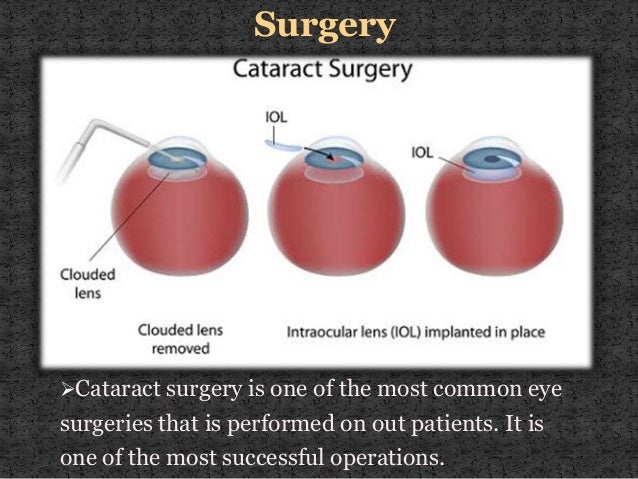Cataract Symptoms, Causes & Treatments (Surgery)