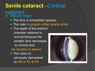 immature senile cataract iris shadow Images High... CATARACT-VVL.ppt