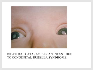 BILATERAL CATARACTS IN AN INFANT DUE
TO CONGENITAL RUBELLA SYNDROME
 