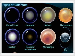Cataract | PPT