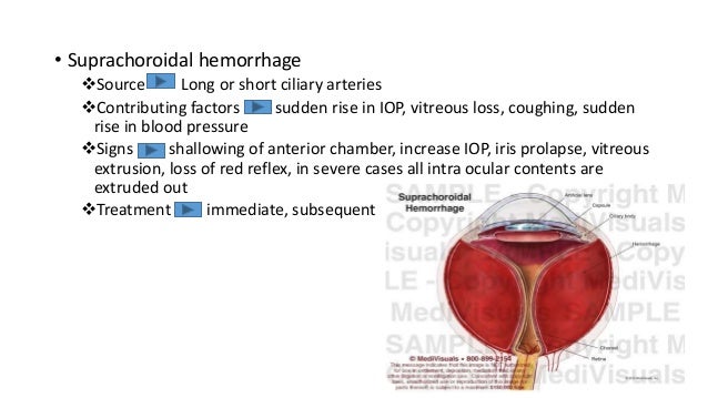 Fragmentation 10 O Suprachoroidal Hemorrhage Fragmentation 10 O Suprachoroidal Hemorrhage