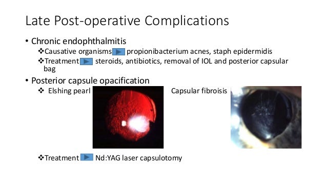 Cataract surgery types and per, early post op and late