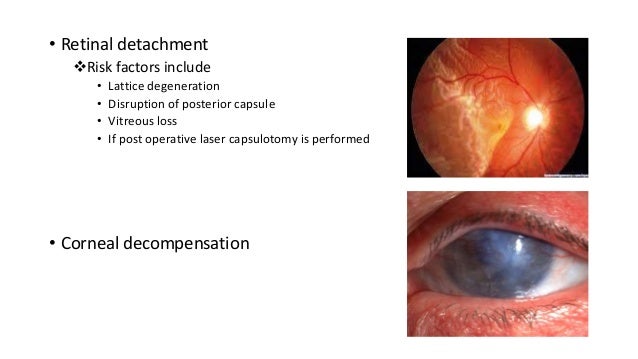 Cataract surgery types and per, early post op and late