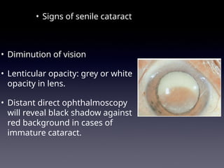immature senile cataract iris shadow Images High... Cataract and Glaucoma disease of the eyeppt | PPT