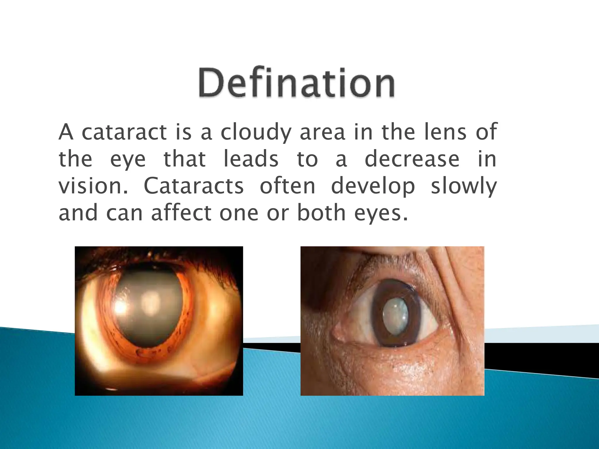 A cataract is a cloudy area in the lens of
the eye that leads to a decrease in
vision. Cataracts often develop slowly
and can affect one or both eyes.
 