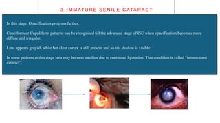Cataract Class for UG medical students.pptx