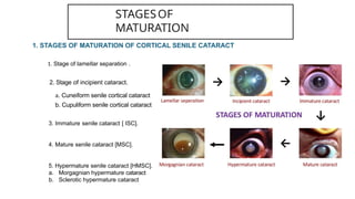 Cataract Development Example Cataract Class for UG medical students.pptx