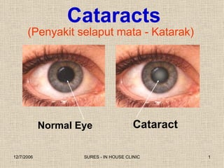 (Penyakit selaput mata - Katarak) Cataract Normal Eye Cataracts 