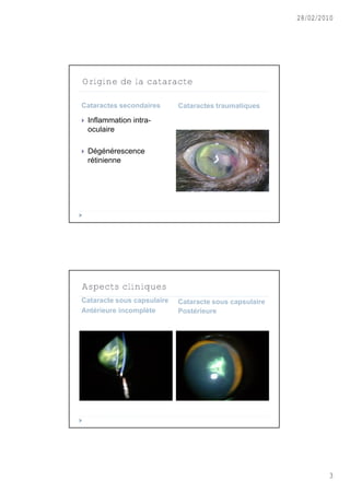 28/02/2010




Origine de la cataracte

Cataractes secondaires      Cataractes traumatiques

   Inflammation intra-
    oculaire

   Dégénérescence
    rétinienne




Aspects cliniques
Cataracte sous capsulaire   Cataracte sous capsulaire
Antérieure incomplète       Postérieure




                                                                3
 