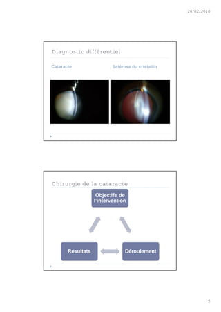 28/02/2010




Diagnostic différentiel

Cataracte                  Scl€rose du cristallin




Chirurgie de la cataracte
                    Objectifs de
                   l’intervention




       R€sultats                 D€roulement




                                                            5
 
