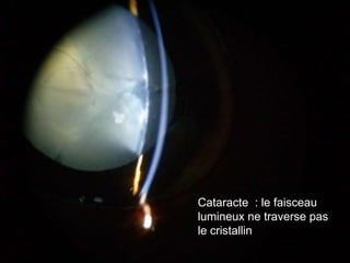 Cataracte : le faisceau
lumineux ne traverse pas
le cristallin
 