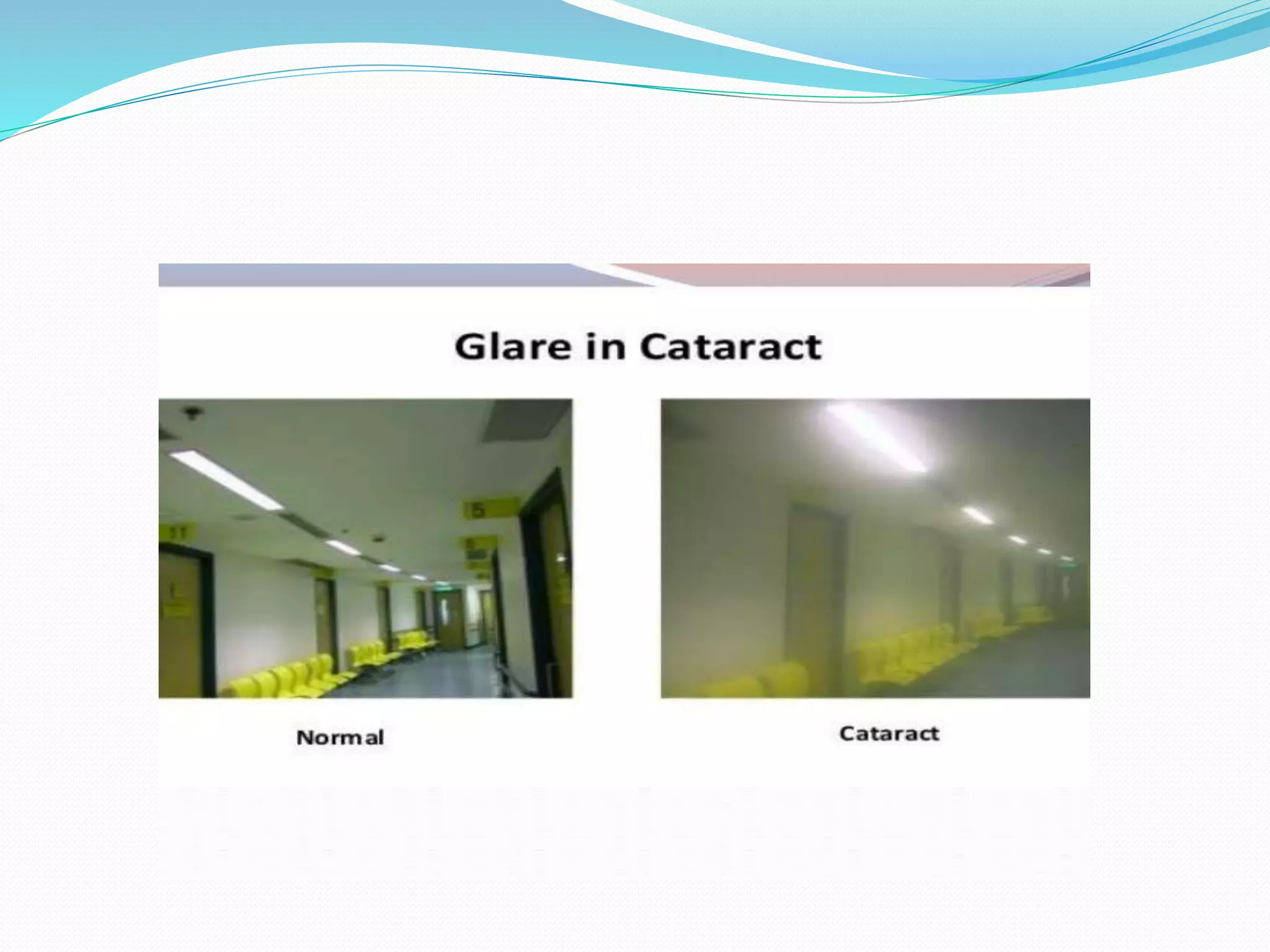 Cataract evaluation ppt PPT