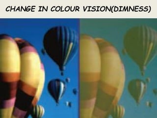 Dimness Vision Examples Cataract Lec.ppt.pdf, define, objective refraction, subjective ...