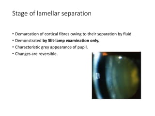 Stage of lamellar separation
• Demarcation of cortical fibres owing to their separation by fluid.
• Demonstrated by Slit-lamp examination only.
• Characteristic grey appearance of pupil.
• Changes are reversible.
 