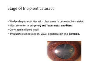 Stage of Incipient cataract
• Wedge shaped opacities with clear areas in between( Lens striae).
• Most common in periphery and lower nasal quadrant.
• Only seen in dilated pupil.
• Irregularities in refraction, visual deterioration and polyopia.
 