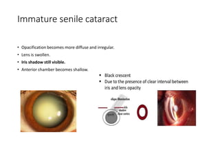 Immature senile cataract
• Opacification becomes more diffuse and irregular.
• Lens is swollen.
• Iris shadow still visible.
• Anterior chamber becomes shallow.
 