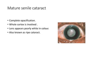 Mature senile cataract
• Complete opacification.
• Whole cortex is involved .
• Lens appears pearly white in colour.
• Also known as ripe cataract.
 