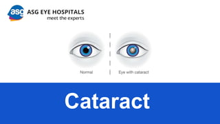 Cataract
 