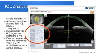 Diagnostic exams for a premium cataract surgery | PPTX