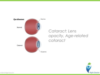 Cataract: Lens
                      opacity, Age-related
                      cataract




© 2012 Right Doctor
 
