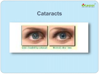 Cataracts
 