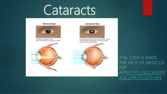 Cataracts
THIS SLIDE IS MADE
THE HELP OF MEDICOS
PDF
APP
.HTTPS://BOOKAPP
.P
AGE.LINK/SLIDESHARE
 