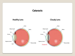 CATARACT SEMINAR PRESENTATION WITH PATHOPHYSIOLOGY | PDF