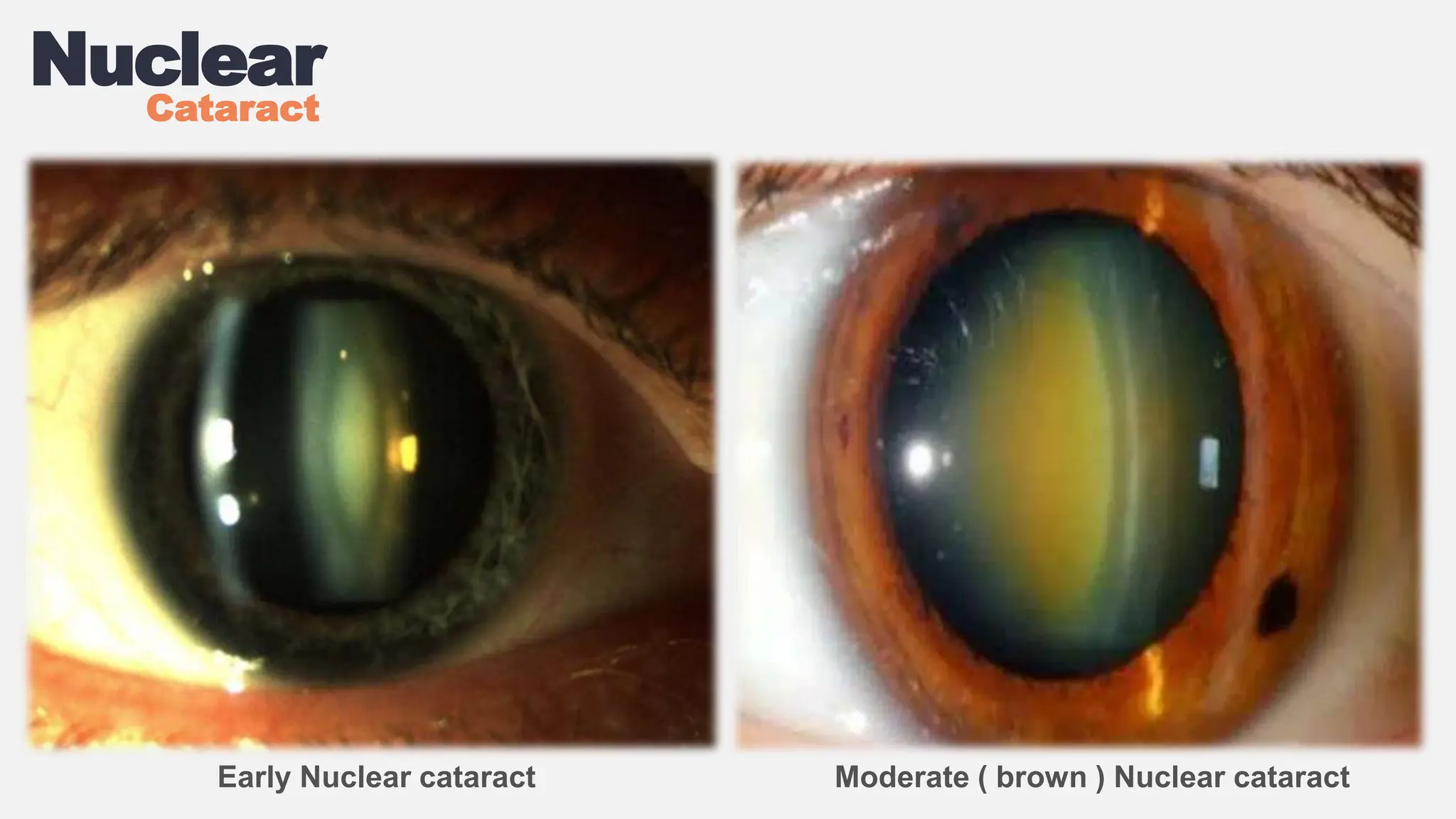 Cataract Slide Pptx