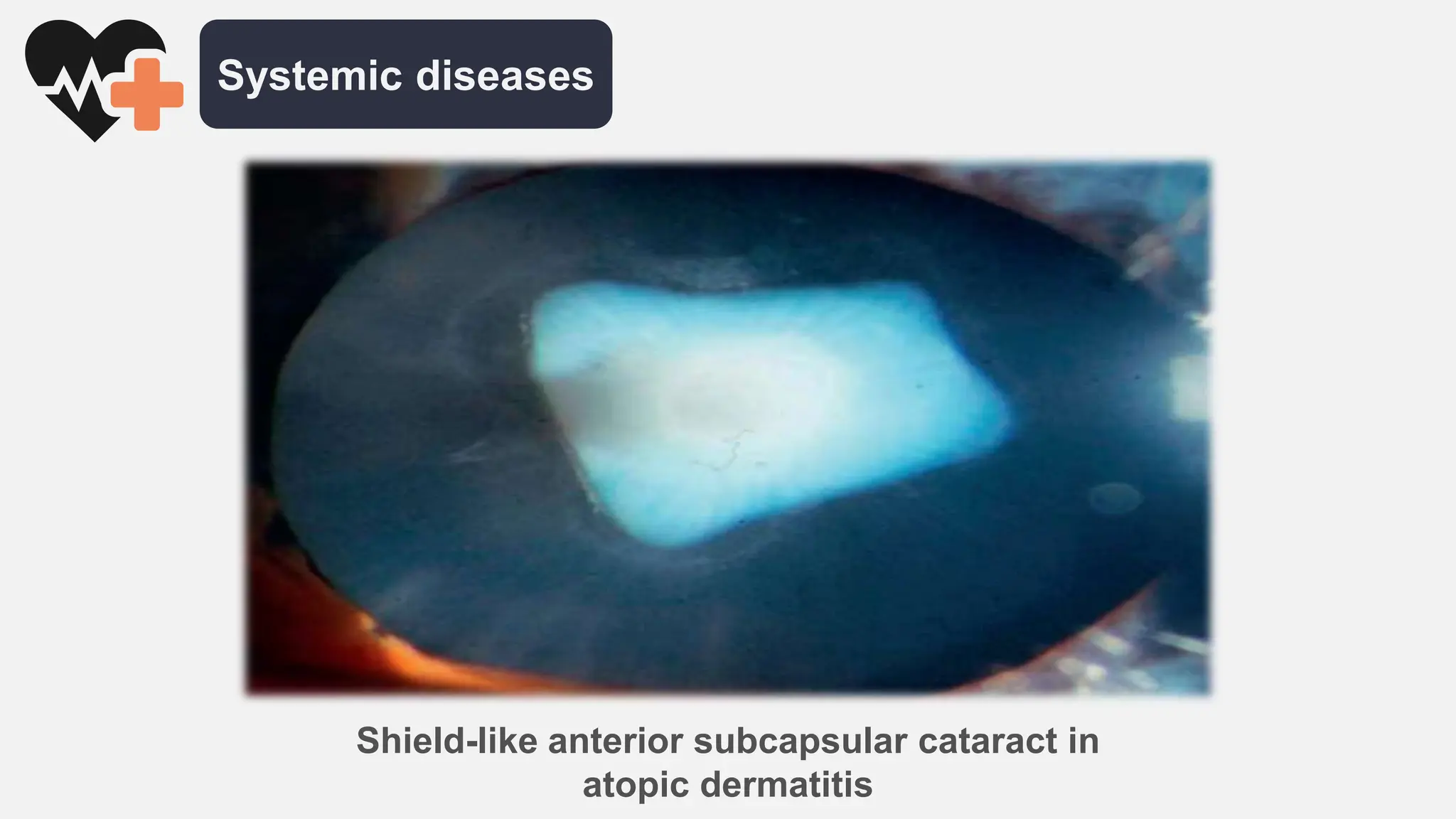 Cataract Slide Pptx
